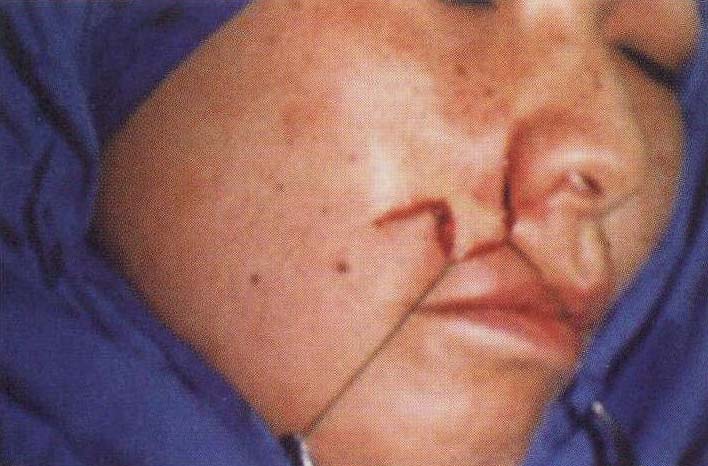 典型病例:改良菱形皮瓣修复右侧上唇基底细胞癌切除后皮肤软组织缺损